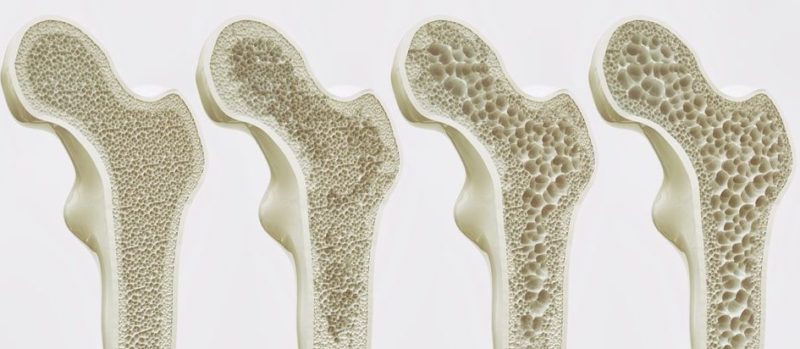 Tulang menjadi lebih rapuh karena osteoporosis.